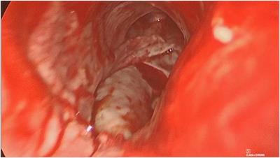 Video-assisted transcervical-transtracheal repair of posterior wall laceration of thoracic trachea: A new approach. Case Report